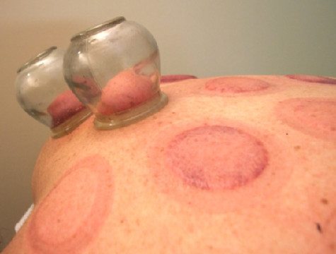 hickey on cupping u2013 science based medicine hickey on cupping u2013 science based medicine