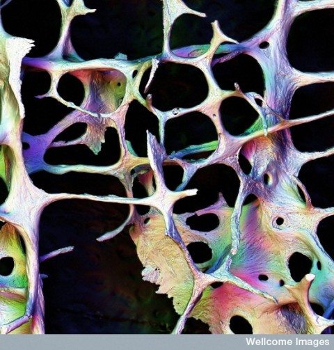 B0003853 Osteoporotic bone - fully focused image Credit: Professor Alan Boyde. Wellcome Images images@wellcome.ac.uk http://images.wellcome.ac.uk Scanning electron micrograph of osteoporotic bone. This sample shows the 4th lumbar vertebra of an 89 year old woman with osteoporosis showing very thin, and some fractured trabeculae. This SEM image has been reconstructed from a series of images in different focal planes to give a completely focused picture of the bone. This enables a much clearer picture to be gained of the osteoclast resorption activity within the bone. The field of view is 2.7mm wide. Scanning electron micrograph Published: - Copyrighted work available under Creative Commons by-nc-nd 2.0 UK, see http://images.wellcome.ac.uk/indexplus/page/Prices.html