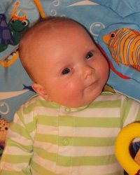 A right sided congenital torticollis