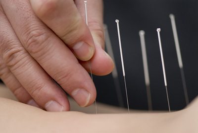 Acupuncture needling