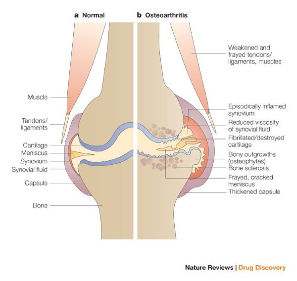 What is the most effective treatment for fluid in the knee joint?