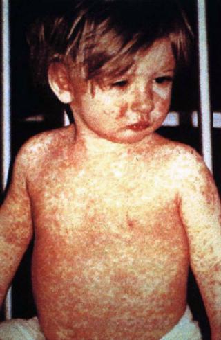 From the CDC Public Health Image Library #132 via the Wikimedia commons. Child with classic measles day-four rash.