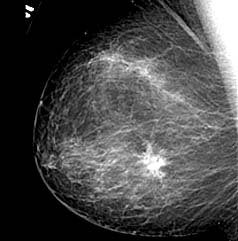 Mandatory breast density reporting legislation: The law outpaces science, and not in a good way 