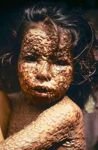 A child with smallpox; the cost of unscientific medicine. This is why science-based medicine matters.