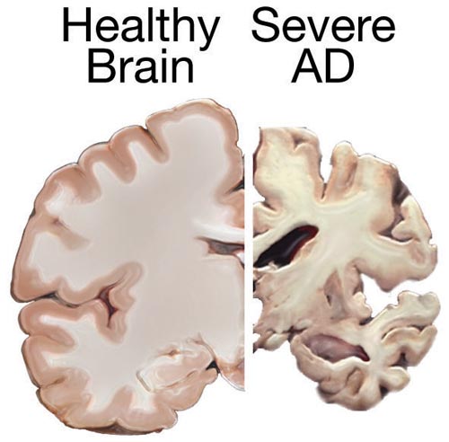 Post-mortem cross sections of a healthy brain (left) and a brain with advanced Alzheimer disease (right), showing characteristic shrinkage.